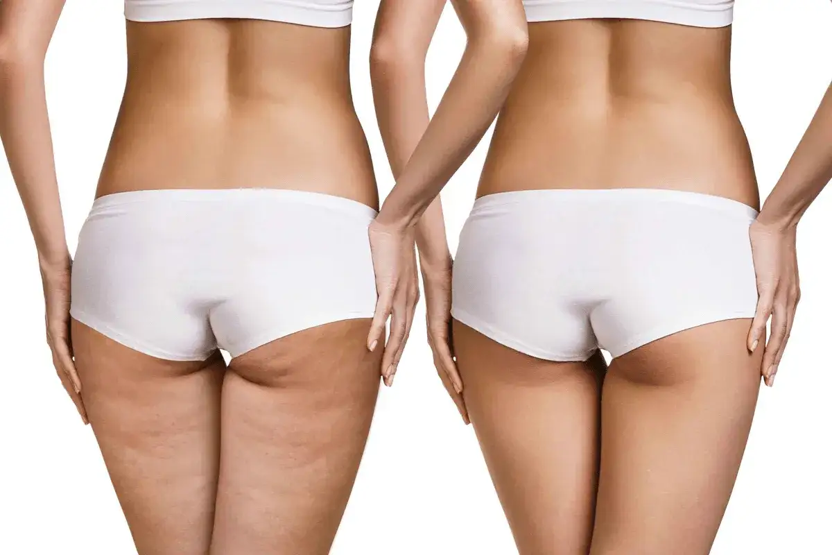 Confronto: gambe con cellulite grave a sinistra, gambe lisce a destra.