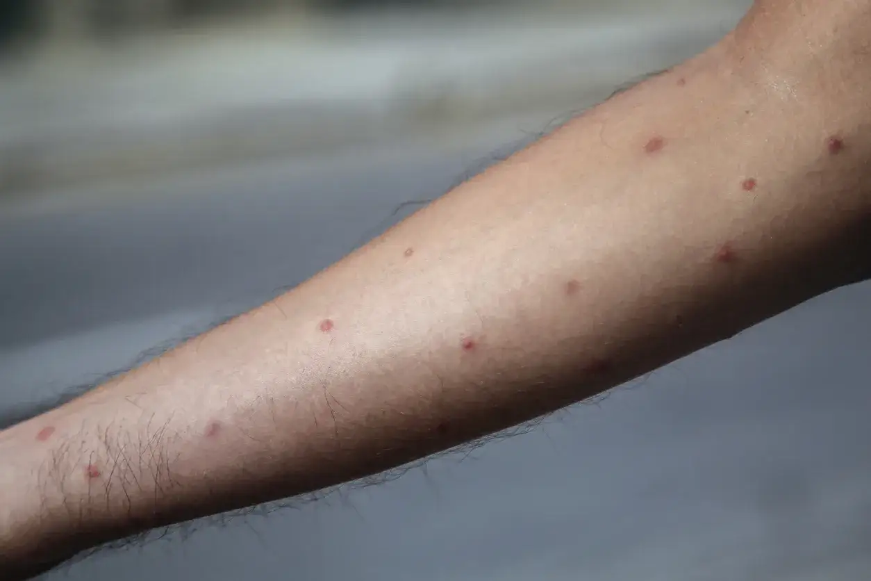 En arm t&auml;ckt av r&ouml;da prickar, troligen efter ett bett av myra.