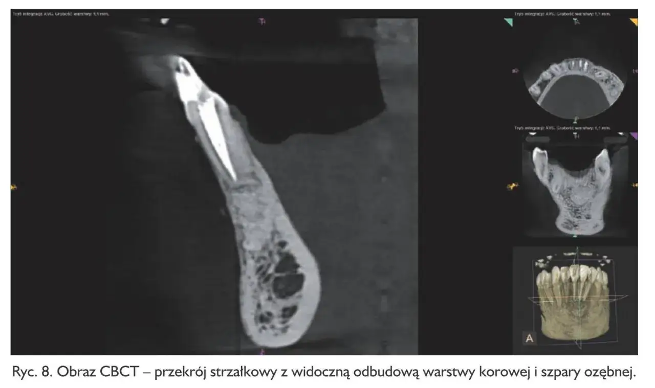 Przekrój strzałkowy CBCT ukazuje zmiany okołowierzchołkowe zęba, odbudowę warstwy korowej i szpary ozębnej.