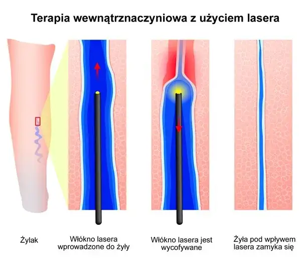 leczenie żylaków laserem i klejem