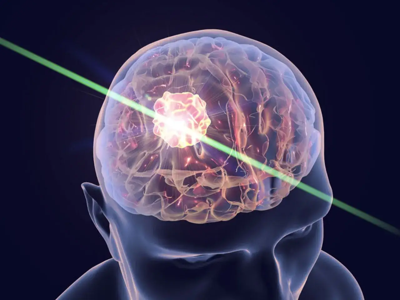 Wizualizacja mózgu z widocznym guzem, glejak 4 stopnia, leczonym zielonym promieniem lasera.