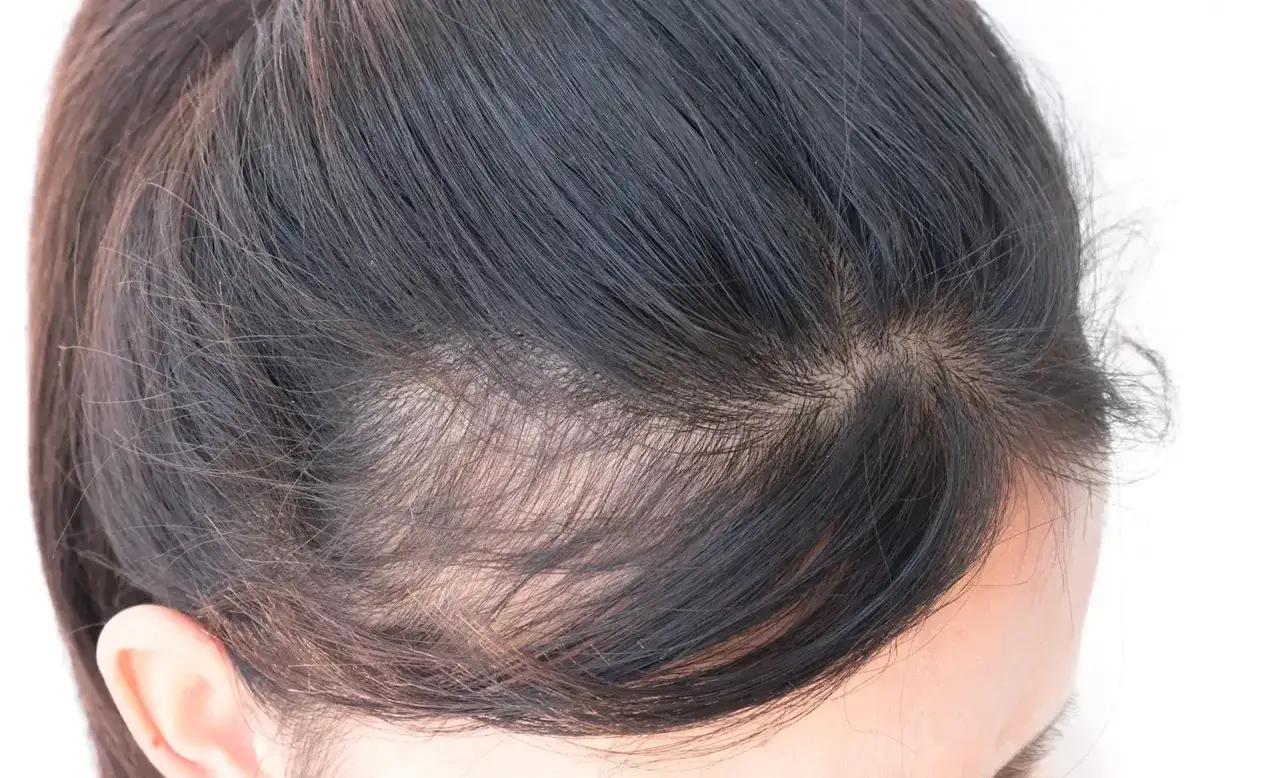 Detalle de entradas pelo mujer, mostrando la l&iacute;nea del cabello y la piel del cuero cabelludo.