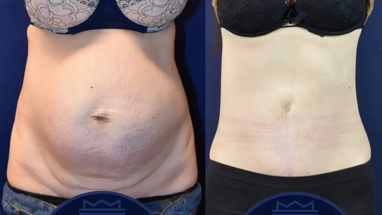 Före- och efterbilder visar resultat av fettsuga magen. En slätare och fastare mage efter ingreppet.