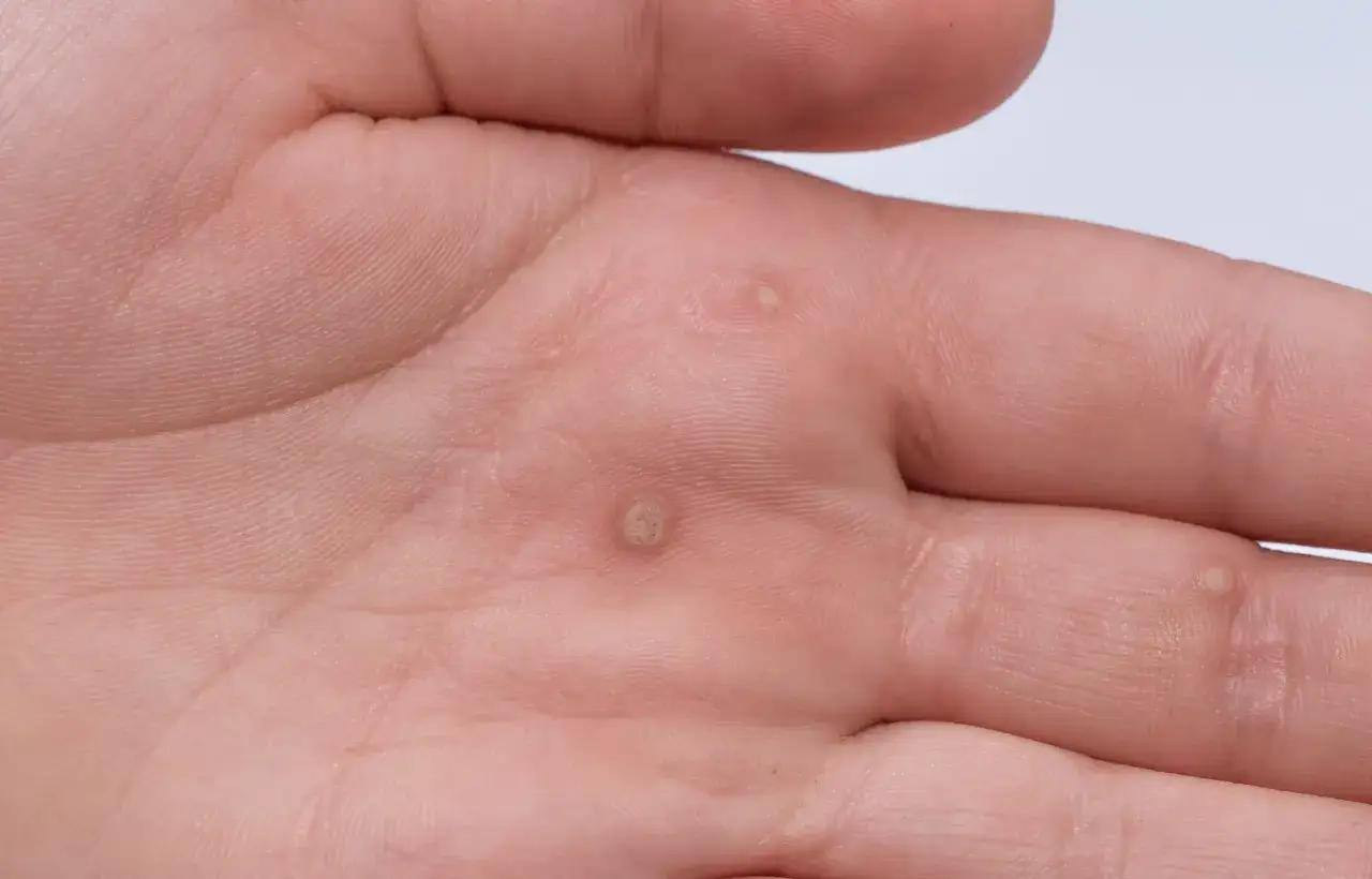 Dłoń mężczyzny z widocznymi brodawkami, które mogą być objawem wirusa HPV.