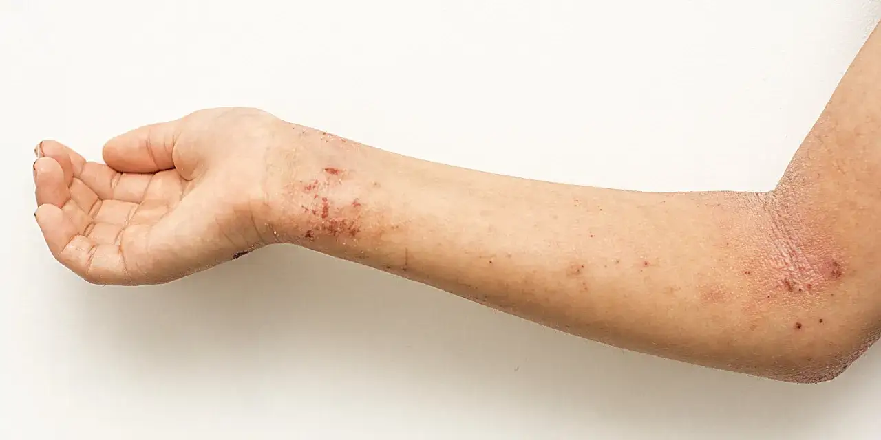 Hautirritationen am Arm und Handgelenk, mögliche Symptome bei zu viel Zink.