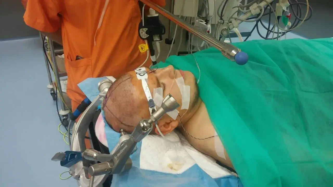 Pacjent na stole operacyjnym, przygotowany do zabiegu neurochirurgicznego. Widoczna aparatura medyczna i przygotowania do trepanacji czaszki.
