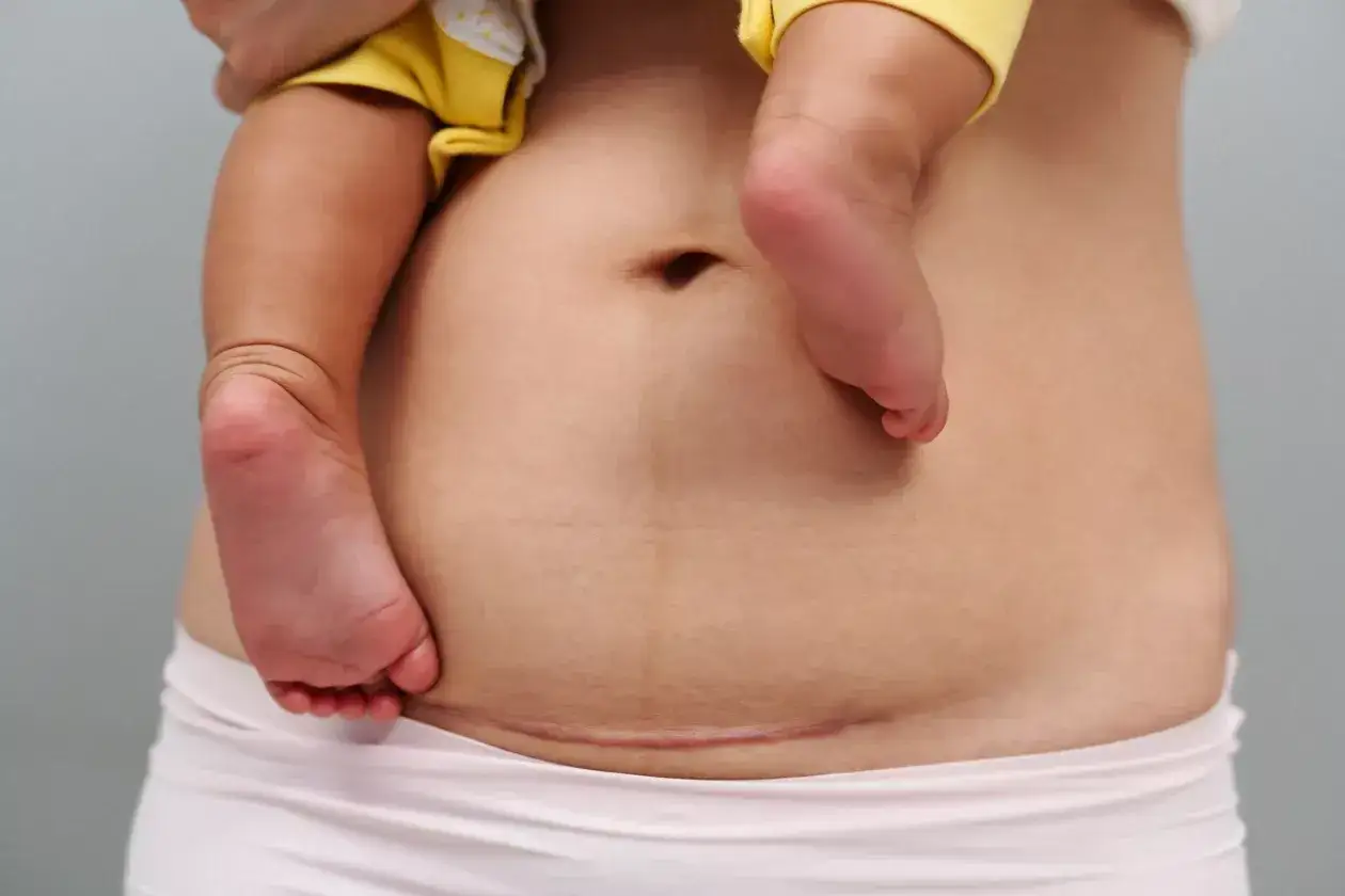 Bauch einer Frau mit Kaiserschnittnarbe und Babyfu&szlig;. Sanfter Wiedereinstieg in den sport nach kaiserschnitt.