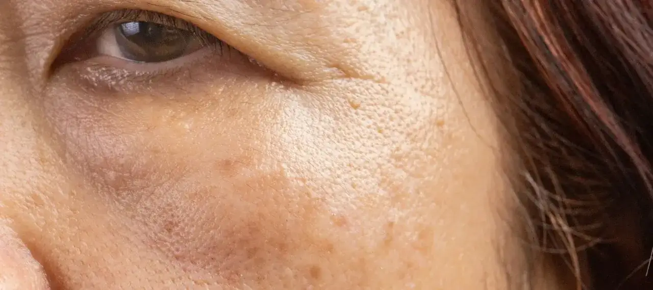 Primer plano de la piel de una persona, mostrando poros dilatados y algunas pecas en la cara, significado de la vida en cada marca.