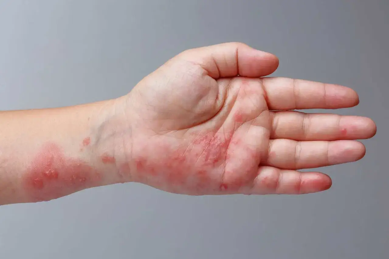 Mano con manchas rojas y erupciones, indicando posible irritación o alergia.