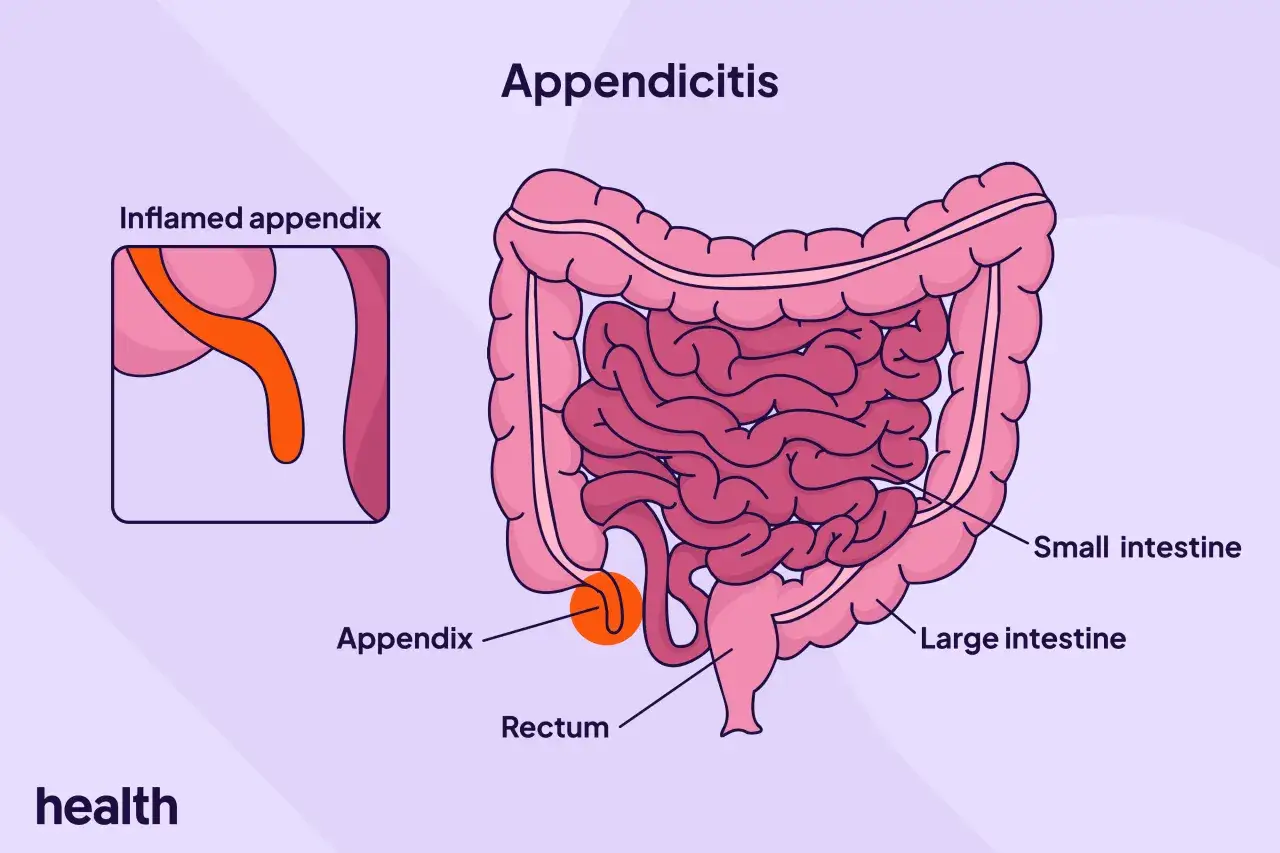 Illustrazione anatomica dell'appendice infiammata, parte dell'intestino. Utile per riconoscere i sintomi appendicite bambini.