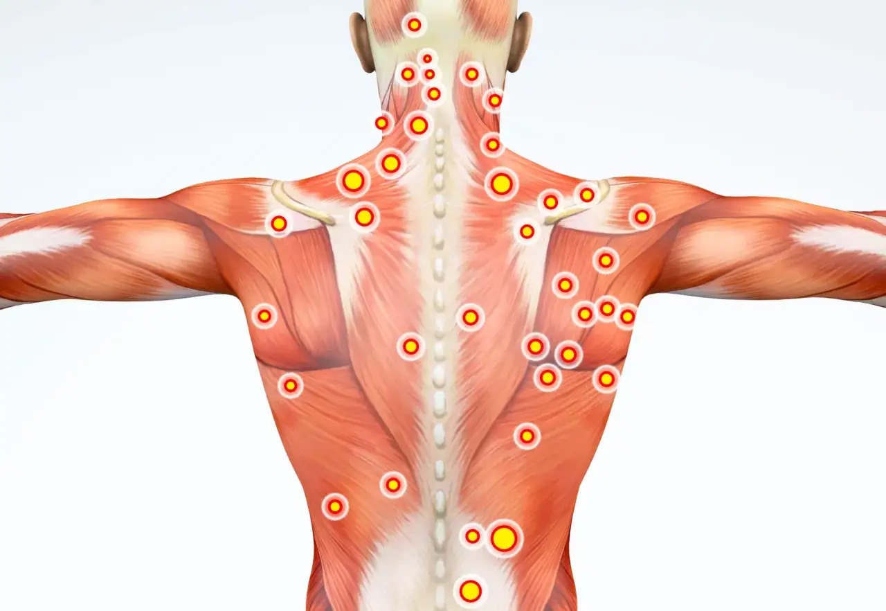 Anatomie du dos humain avec des points rouges et jaunes indiquant des points de d&eacute;clenchement. La traduction de 