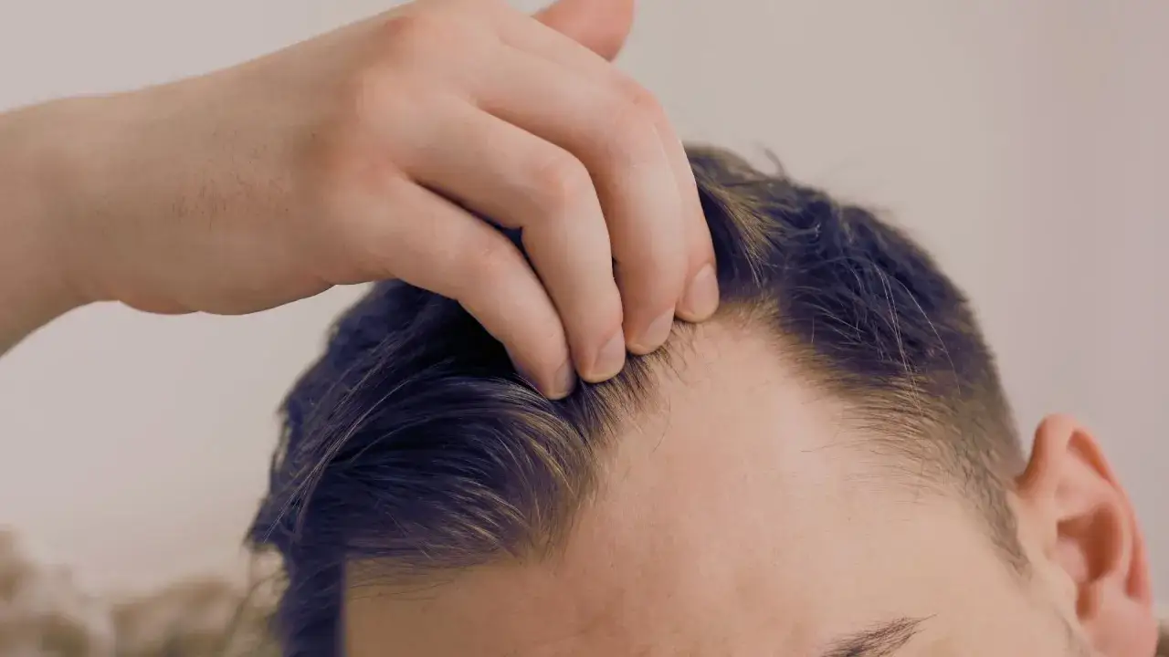 Un hombre se toca la frente, preocupado por la **caída del cabello**. Se observa la línea del cabello retrocediendo.