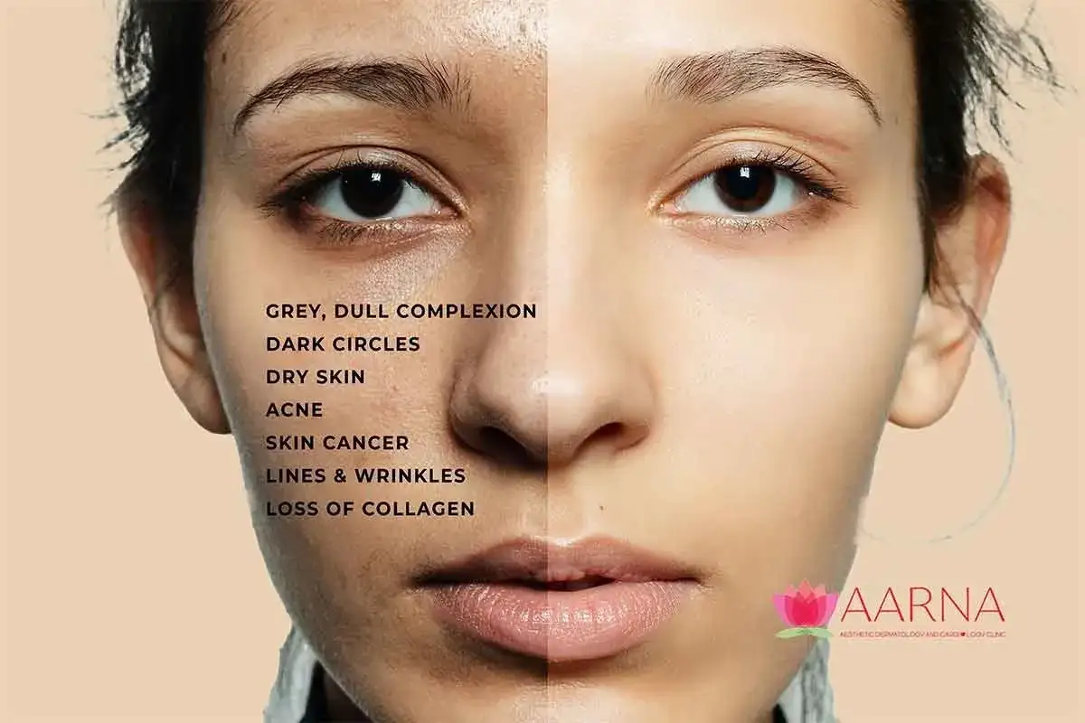 Gespaltene Gesichtshälfte: links graue Haut, Akne, Pickel vom Rauchen; rechts reine Haut.