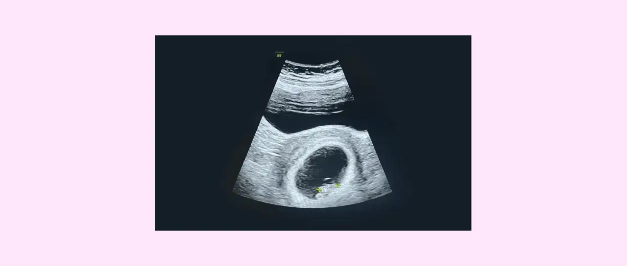 Ecograf&iacute;a muestra un saco gestacional con un embri&oacute;n, indicando el inicio del segundo trimestre de embarazo.