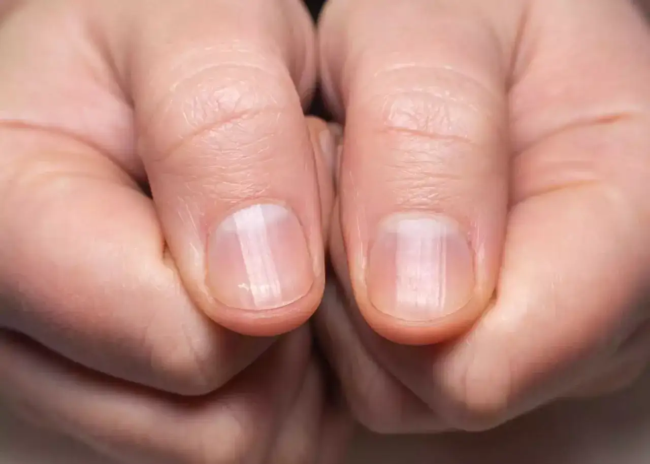 Gros plan sur des ongles montrant des lignes verticales, une possible explication pour pourquoi mes ongles se cassent.