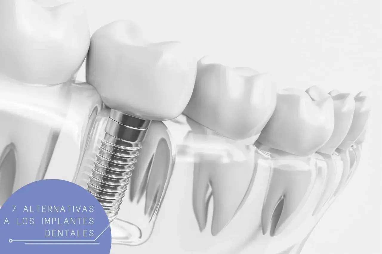 Un implante dental de titanio se muestra anclado en el hueso, junto a dientes blancos y sanos. Texto: