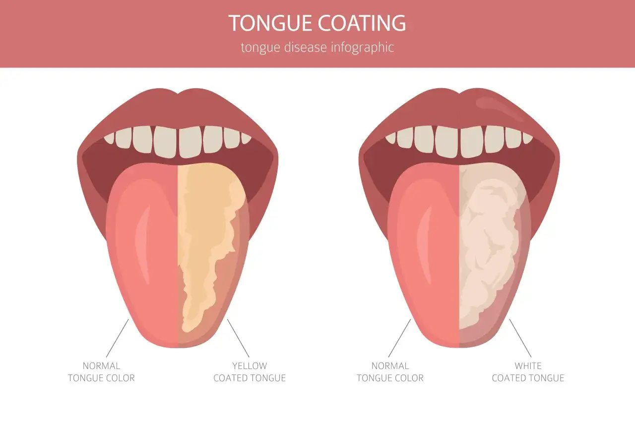 Lingua normale a sinistra, lingua gialla con patina a destra. Confronto visivo di patologie della lingua.