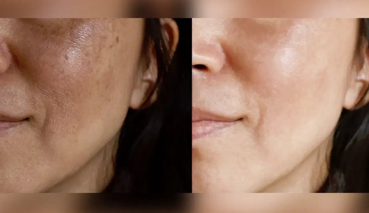 Comparaci&oacute;n de piel con manchas antes y despu&eacute;s. Opiniones sobre amchafibrin para manchas.