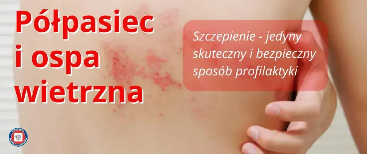 Półpasiec i ospa wietrzna – szczepienie to jedyny skuteczny sposób profilaktyki.