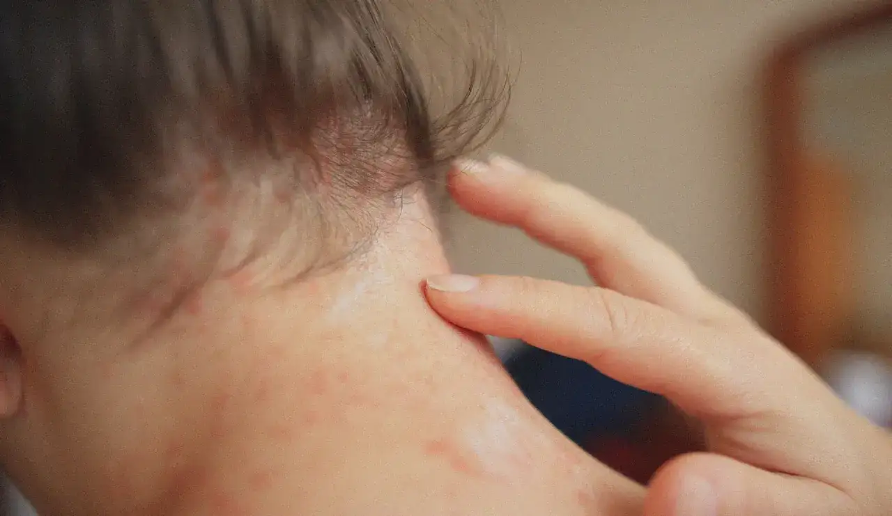 Rougeurs et petits boutons sur la nuque d'un bébé, possiblement dus à une allergie huile de coco. Un doigt touche la zone irritée.
