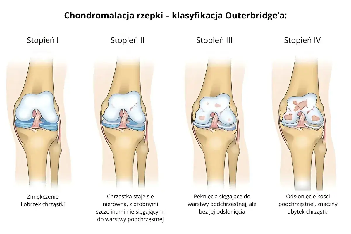 Ilustracja pokazuje cztery stadia chondromalacji rzepki wg Outerbridge'a: od zmiękczenia chrząstki do odsłonięcia kości.