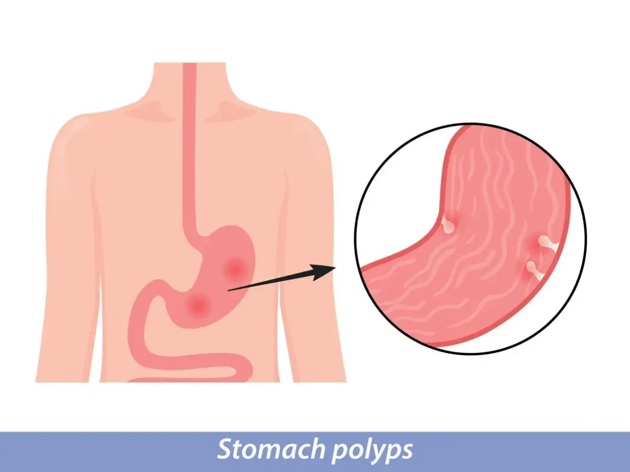 Illustration av mags&auml;cken med synliga polyper. En n&auml;rbild visar flera sm&aring; utv&auml;xter p&aring; mags&auml;ckens insida.