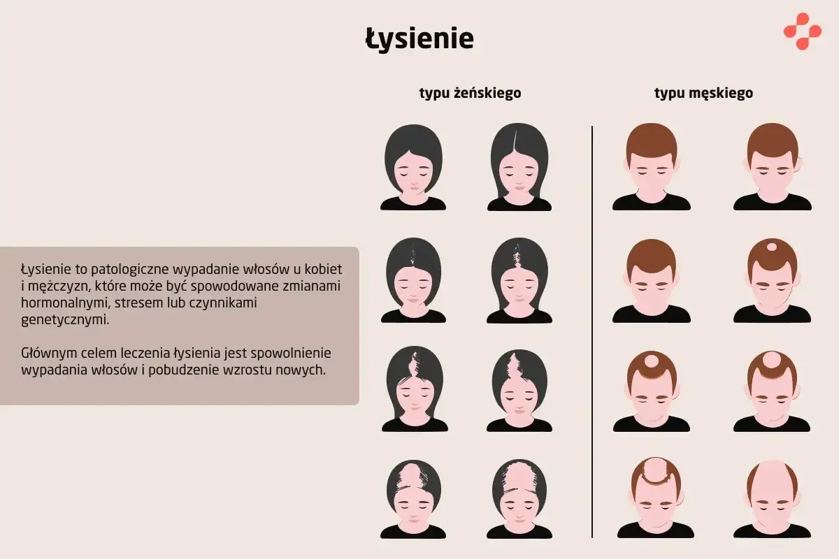 Ilustracja pokazuje różne etapy łysienia u kobiet i mężczyzn, wyjaśniając, że wypadanie włosów przyczyny mogą być hormonalne, stresowe lub genetyczne.