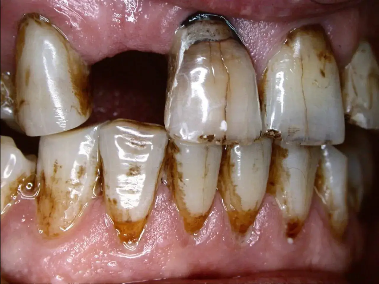 Dientes manchados y da&ntilde;ados, evidencia del efecto negativo del tabaco en nuestros dientes. Se observa sarro y posible caries.