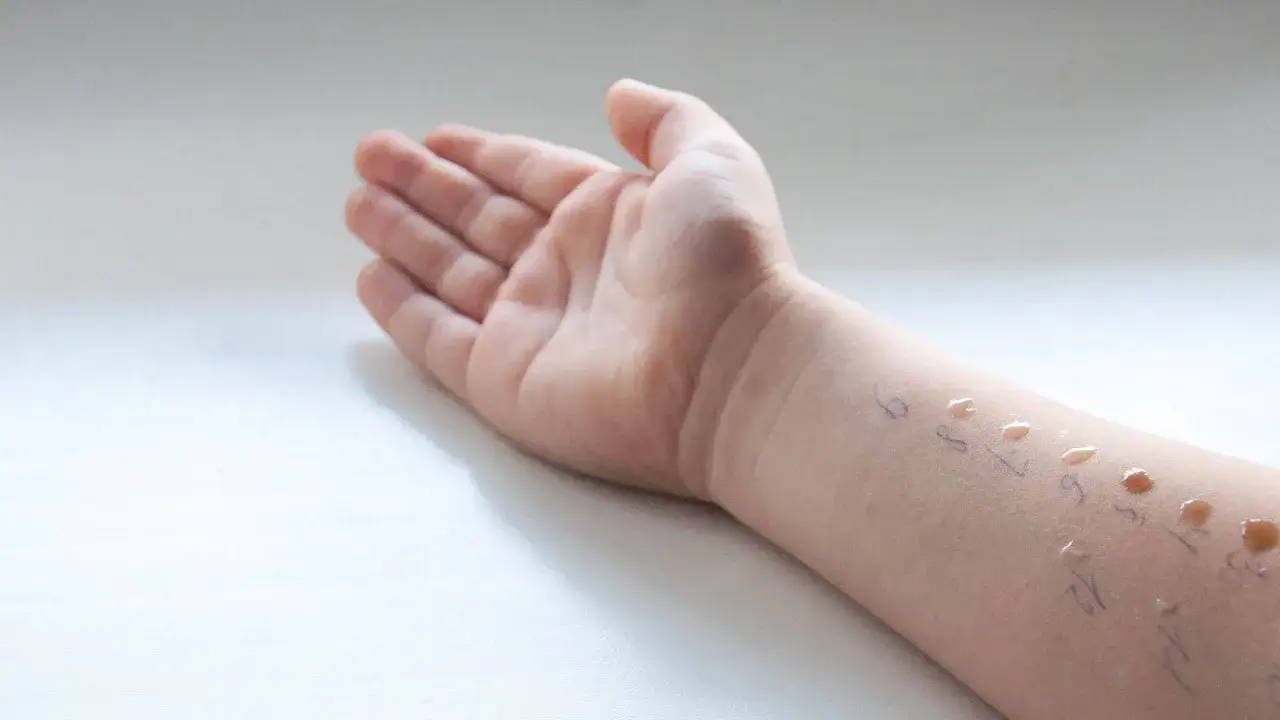Dziecięce ramię z kropelkami płyn&oacute;w i numerami, przygotowanie do test&oacute;w alergicznych u dzieci.