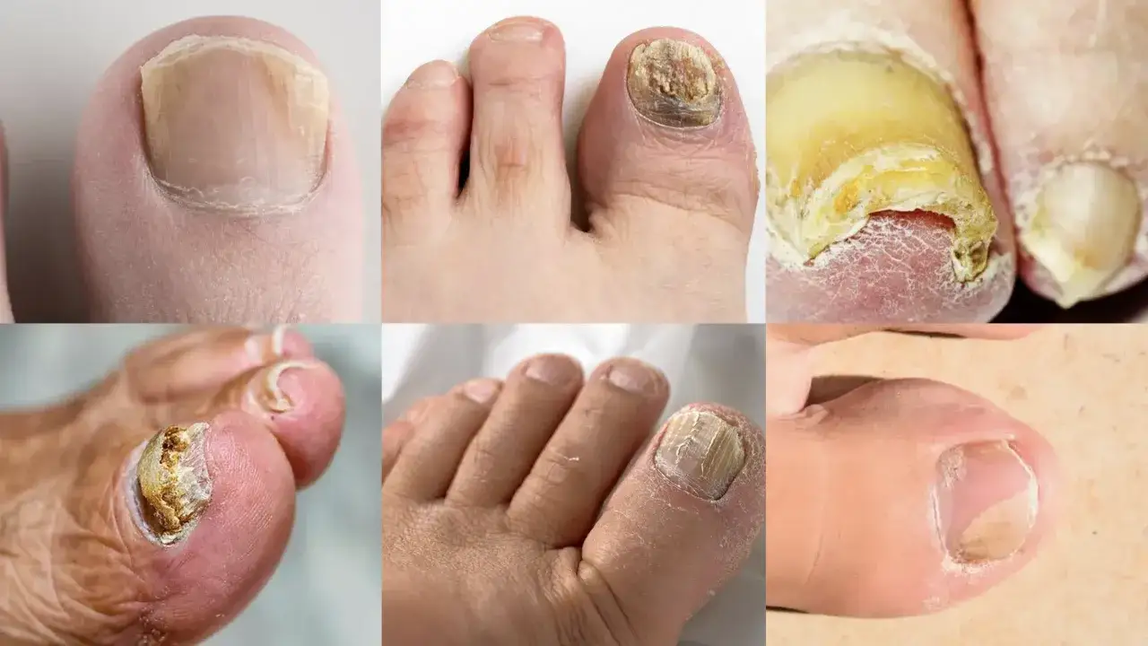 Gros plans montrant des ongles d'orteils affect&eacute;s par une mycose, avec des ongles jaunis, &eacute;paissis et d&eacute;form&eacute;s.