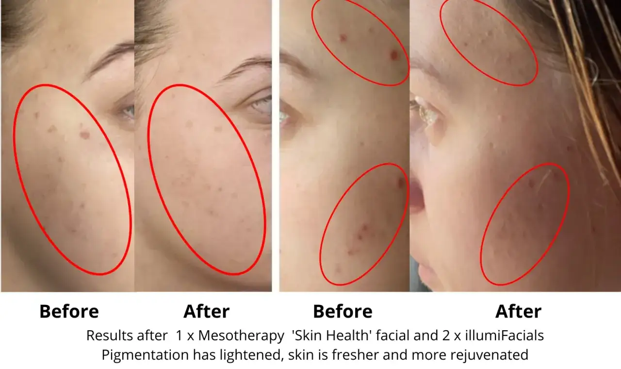 Comparativa antes y después de tratamientos faciales. La piel luce más fresca y rejuvenecida, con pigmentación reducida. ¡Resultados visibles!