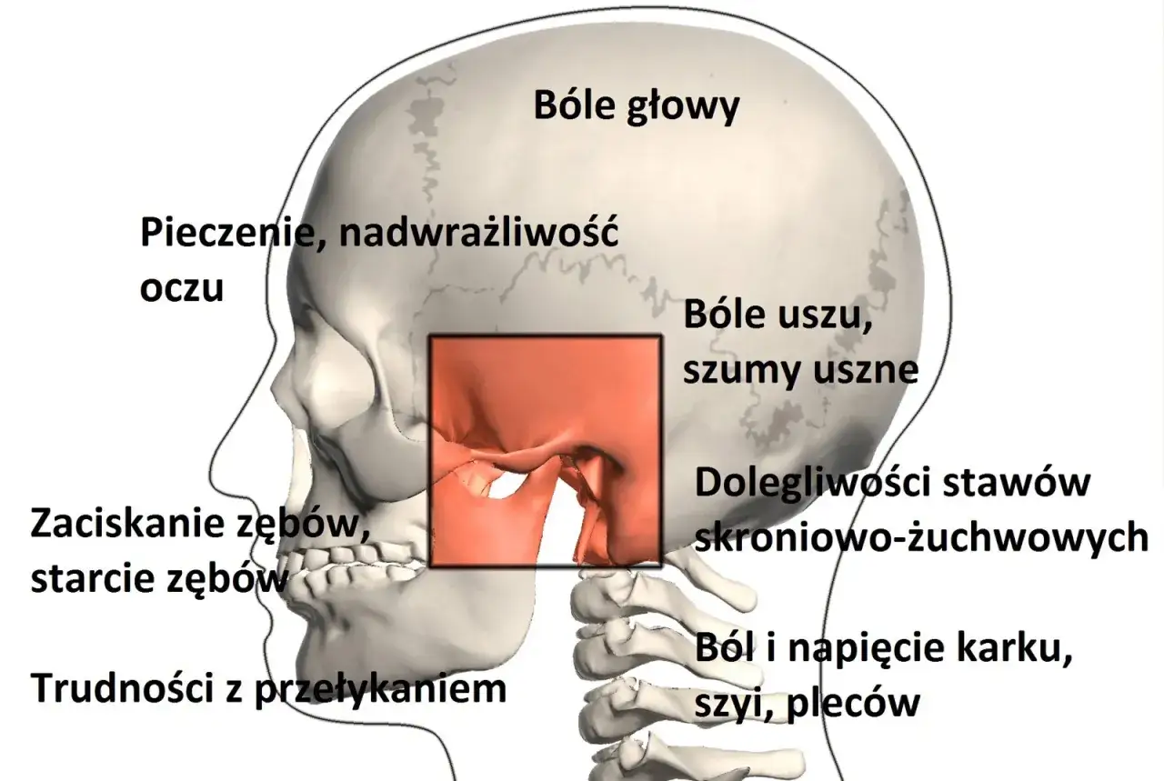 Ilustracja przedstawia czaszkę i kręgosłup z zaznaczonymi objawami bruksizmu: bóle głowy, oczu, uszu, stawów skroniowo-żuchwowych, karku, szyi, pleców, a także zaciskanie i starcie zębów.
