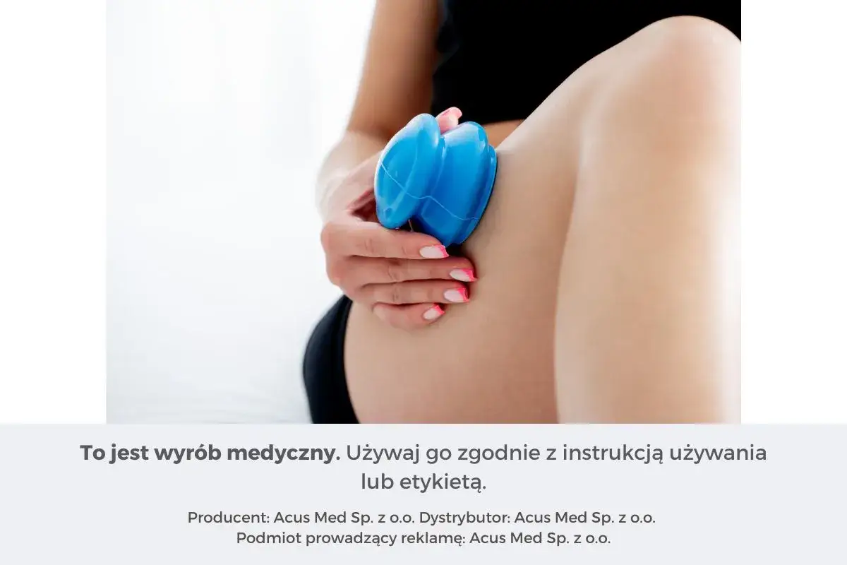 Dłoń z niebieskimi bańkami do masażu chińskiego na udzie.