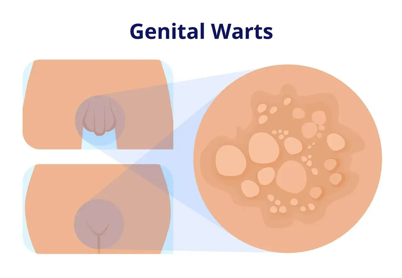 Ilustraci&oacute;n que muestra la diferencia entre verruga y condiloma genital, con un primer plano de m&uacute;ltiples lesiones cut&aacute;neas.