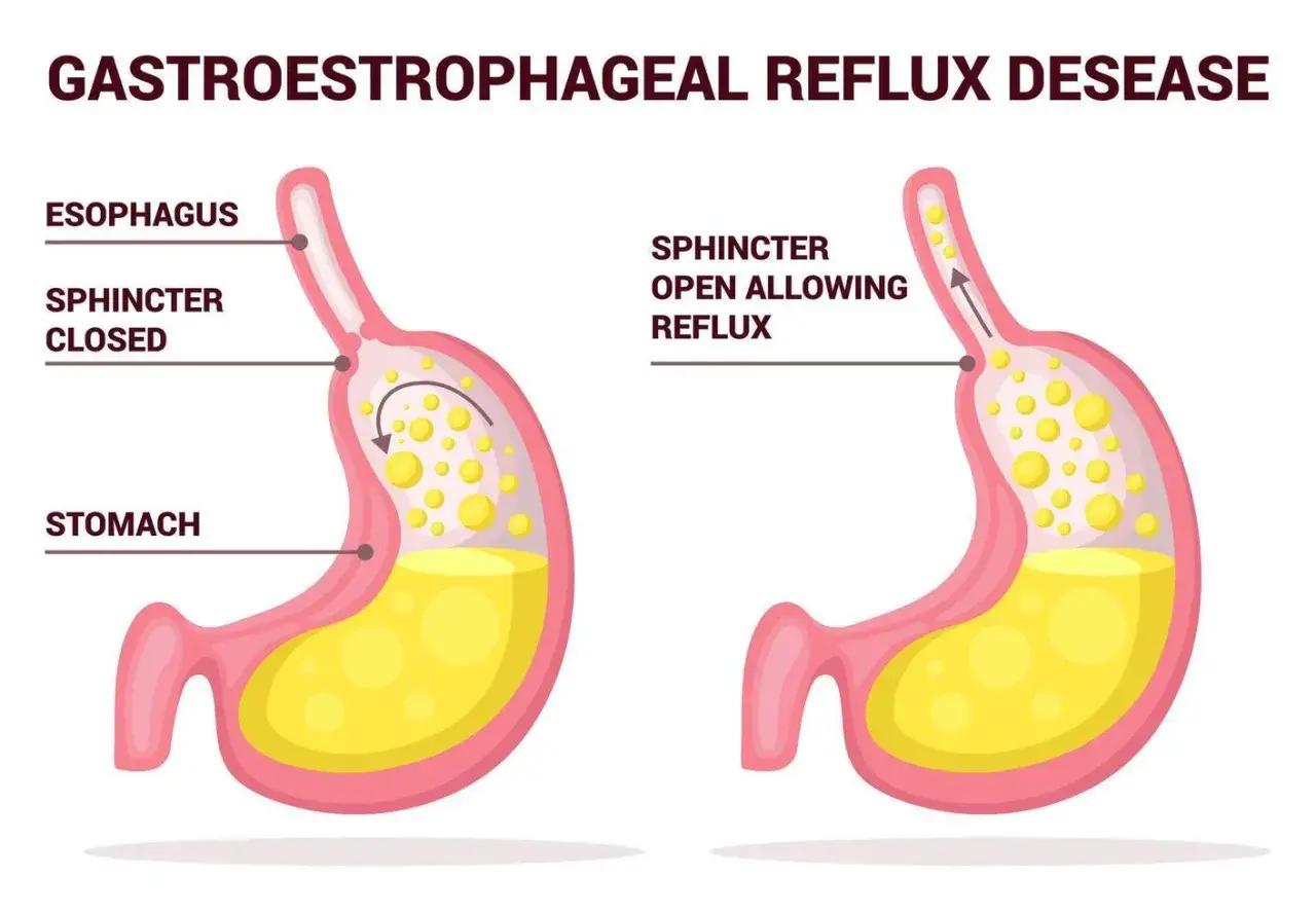 Illustration visar magmunnen som är öppen och tillåter reflux, vilket kan orsaka ont i magen.