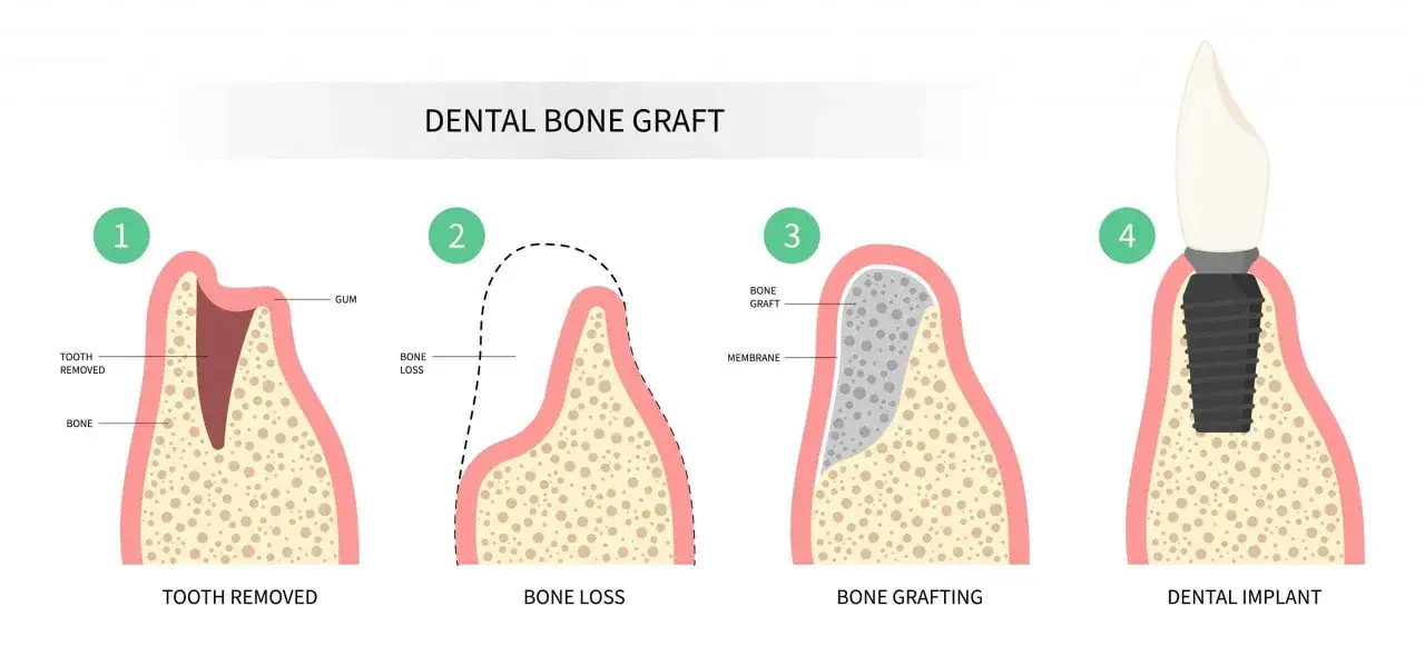 Ilustración muestra la pérdida ósea dental tras extracción, el injerto óseo dental para regenerar el hueso y la colocación final de un implante.