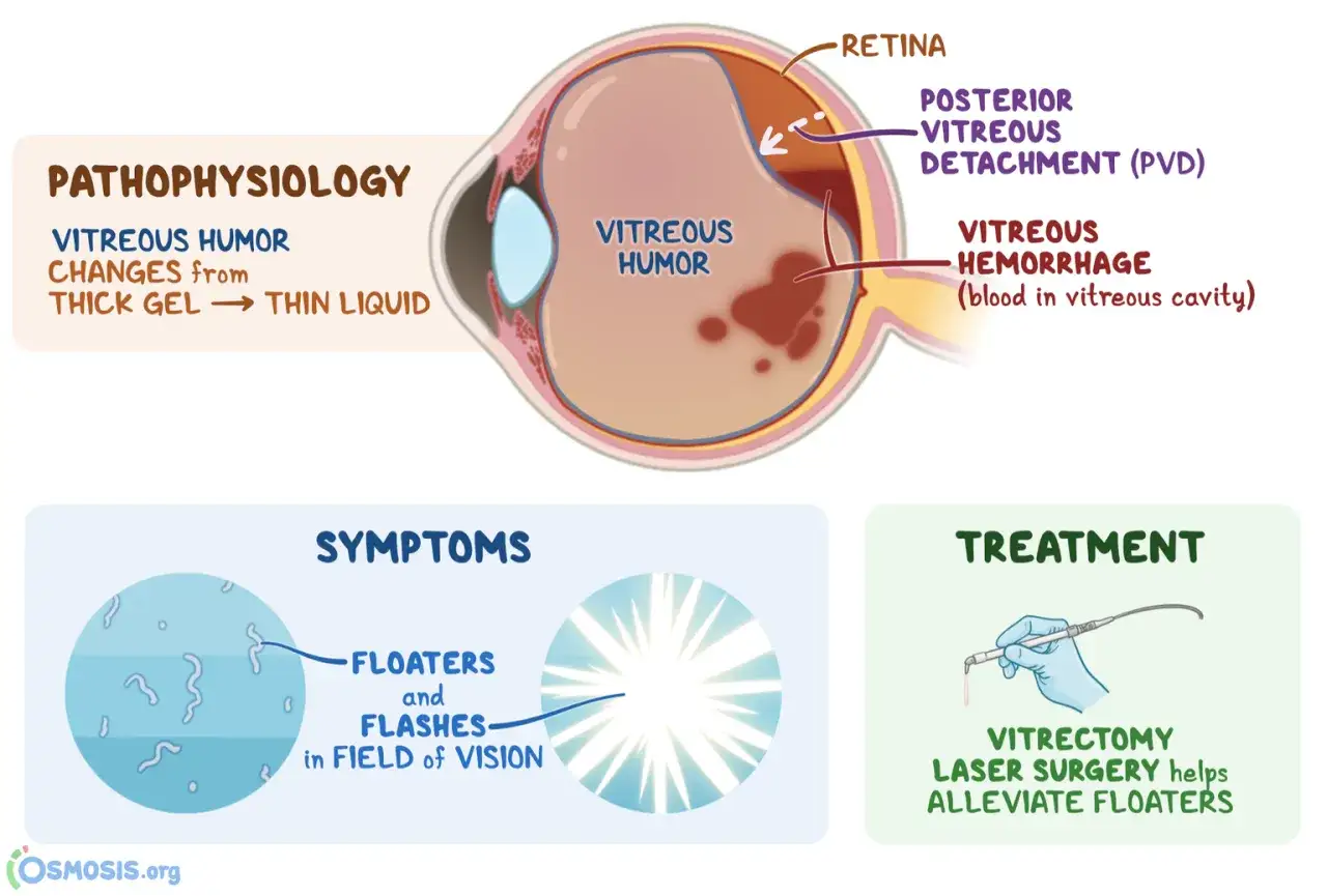 Diagramma oculare che illustra la patofisiologia, i sintomi (floaters, lampi) e il trattamento (vitrectomia) del distacco posteriore del vitreo, una delle cause di lacerazione retinica.