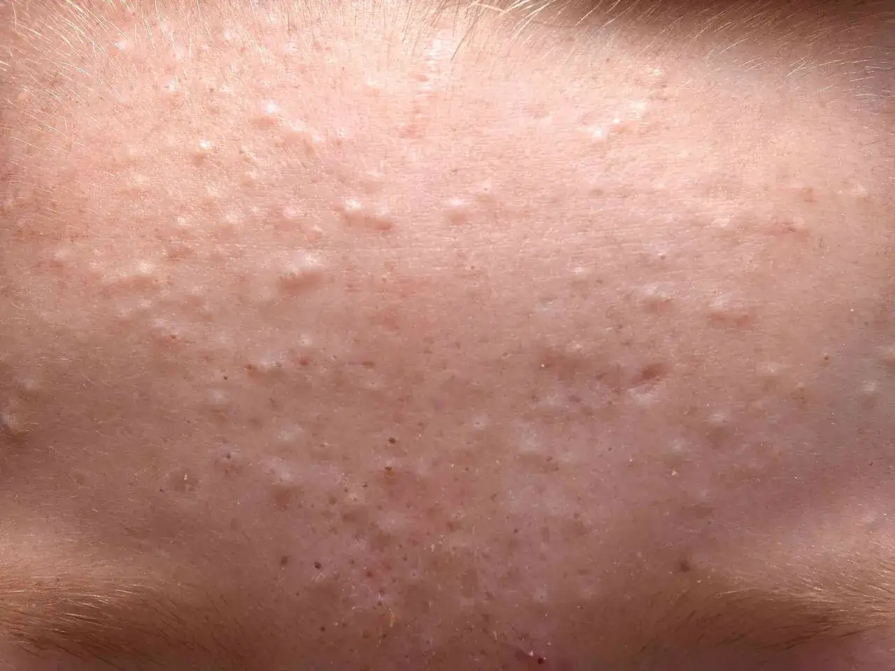 Pelle con numerosi comedoni chiusi, piccole protuberanze biancastre e sottocutanee, visibili sotto la superficie cutanea.