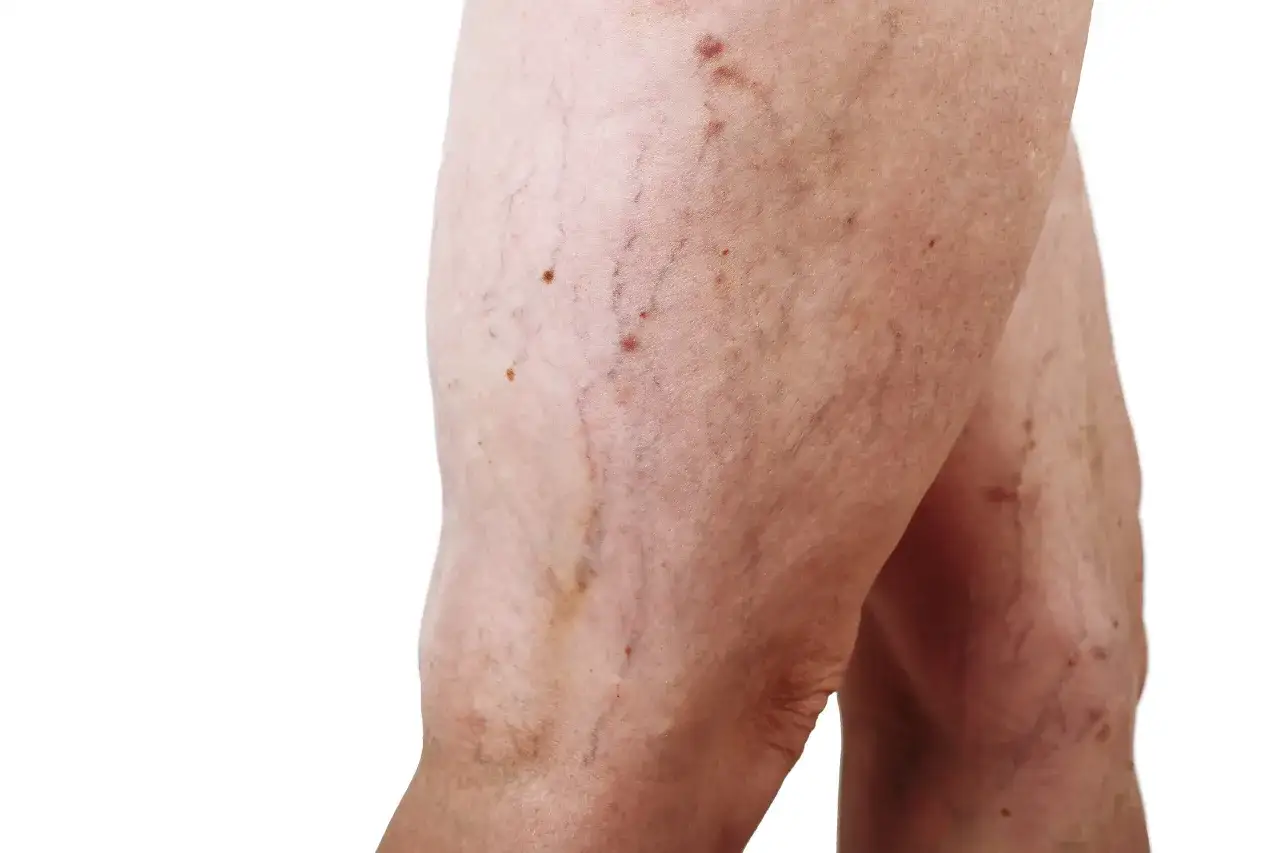 Gambe con teleangectasie e vene visibili. C'&egrave; speranza che i capillari rotti si possano riassorbire.