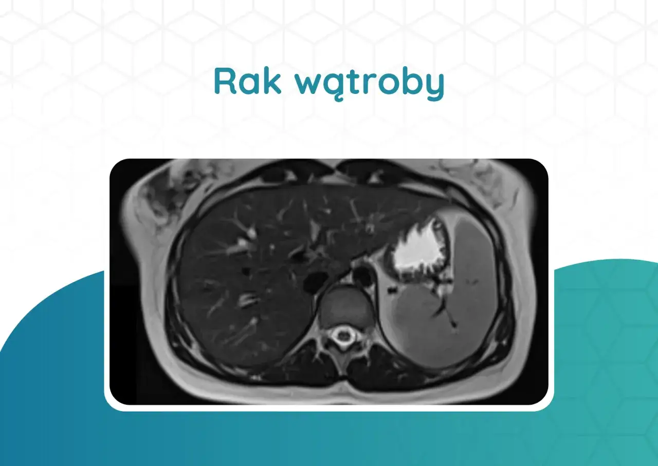 Przekrój MRI wątroby z widocznym guzem. Obraz przedstawia obrazowanie medyczne, które może pomóc w diagnostyce raka wątroby objawy.