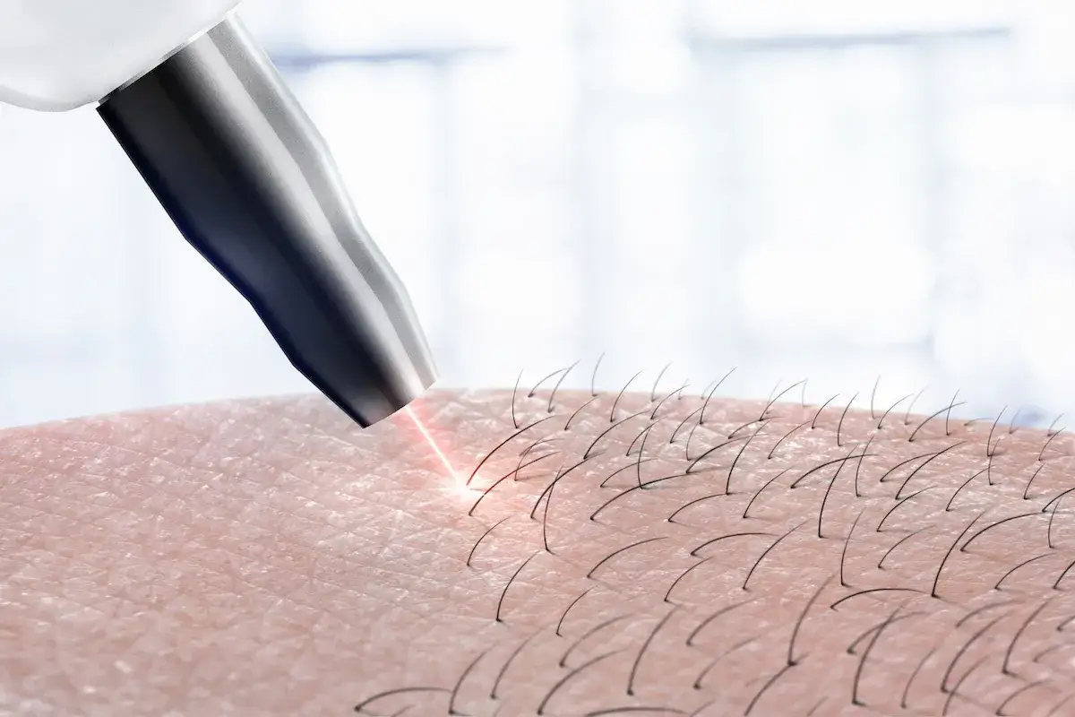 Depilacja laserowa: wiązka światła celuje w włoski na skórze. Czy depilacja laserowa boli? To pytanie zadaje sobie wiele osób.