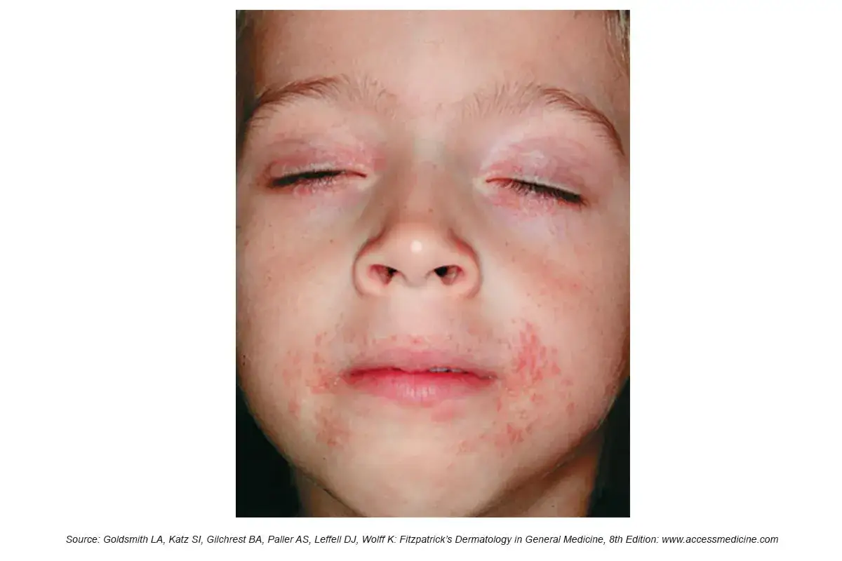 Barn med rodnad och utslag runt munnen, m&ouml;jligen relaterat till perioral dermatit orsakad av stress.