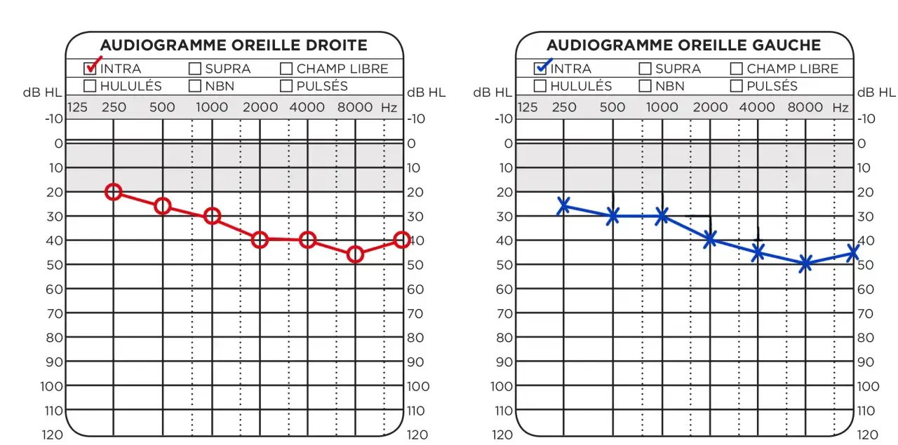 Audiogrammes gauche et droit montrant une perte auditive légère à modérée. Ce test auditif révèle une baisse de l'audition avec l'âge.