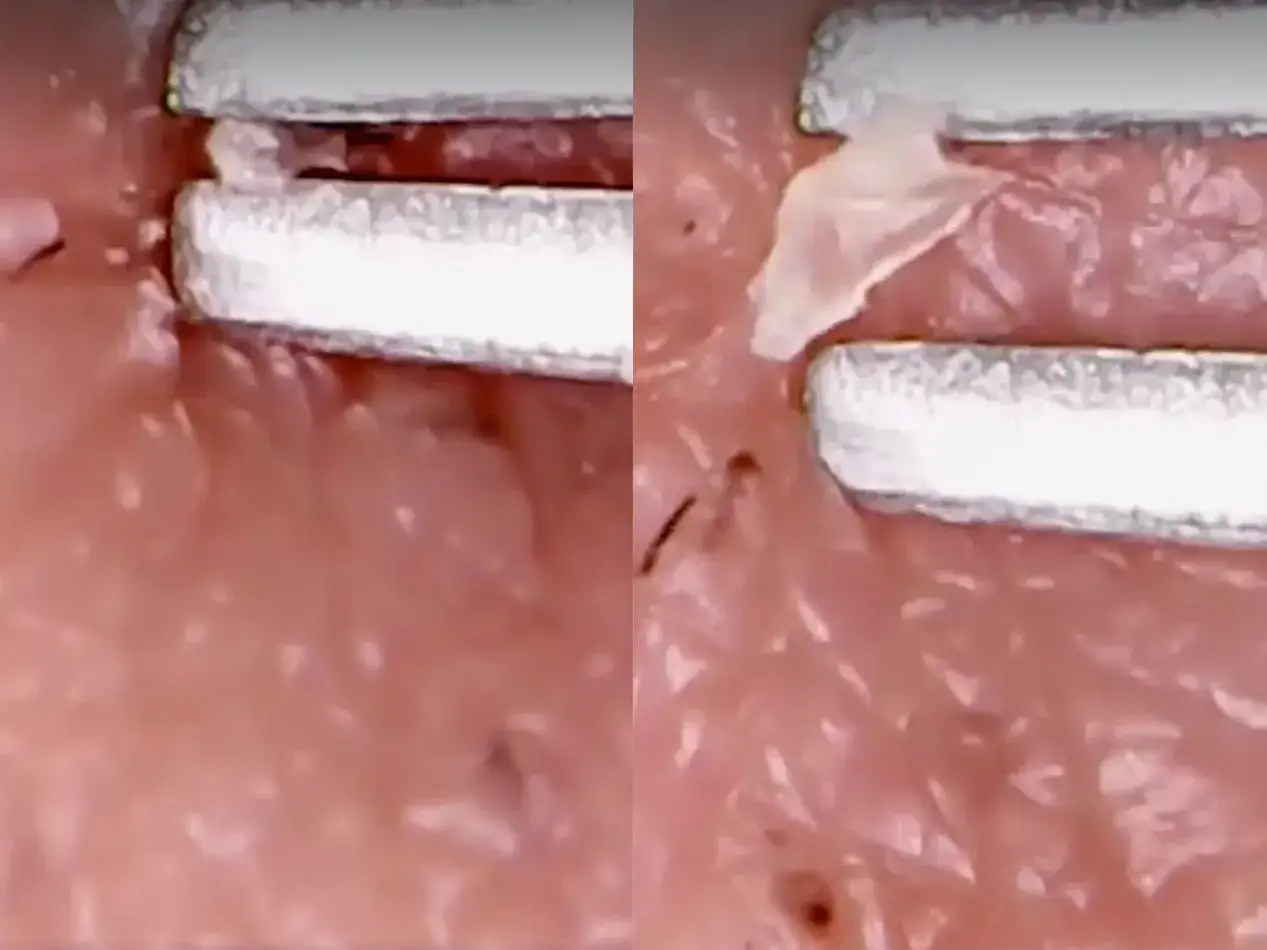 Close-up of a tool extracting a deep blackhead from skin. The left side shows the blackhead before extraction, the right side shows it being removed.