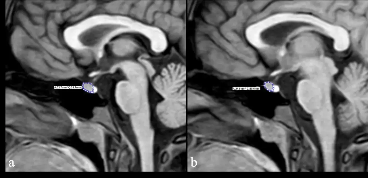Dwa przekroje MRI mózgu, pokazujące przysadkę mózgową. Obraz a: 32.7mm², C: 21.7mm. Obraz b: 24.5mm², C: 18.6mm. Może to być związane z gigantyzmem.