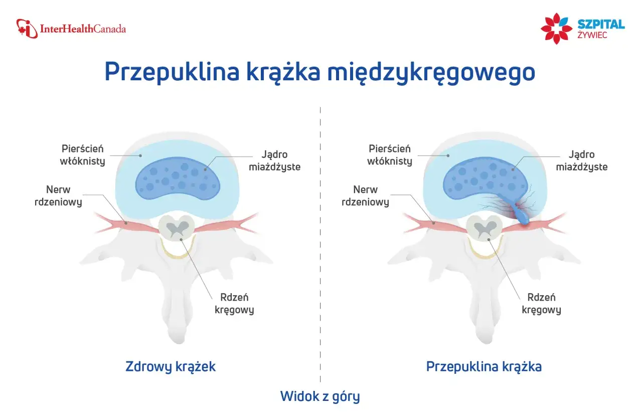 Porównanie zdrowego krążka międzykręgowego z przepukliną. Czy z przepukliną kręgosłupa można pracować? Ilustracja pokazuje ucisk na nerw.