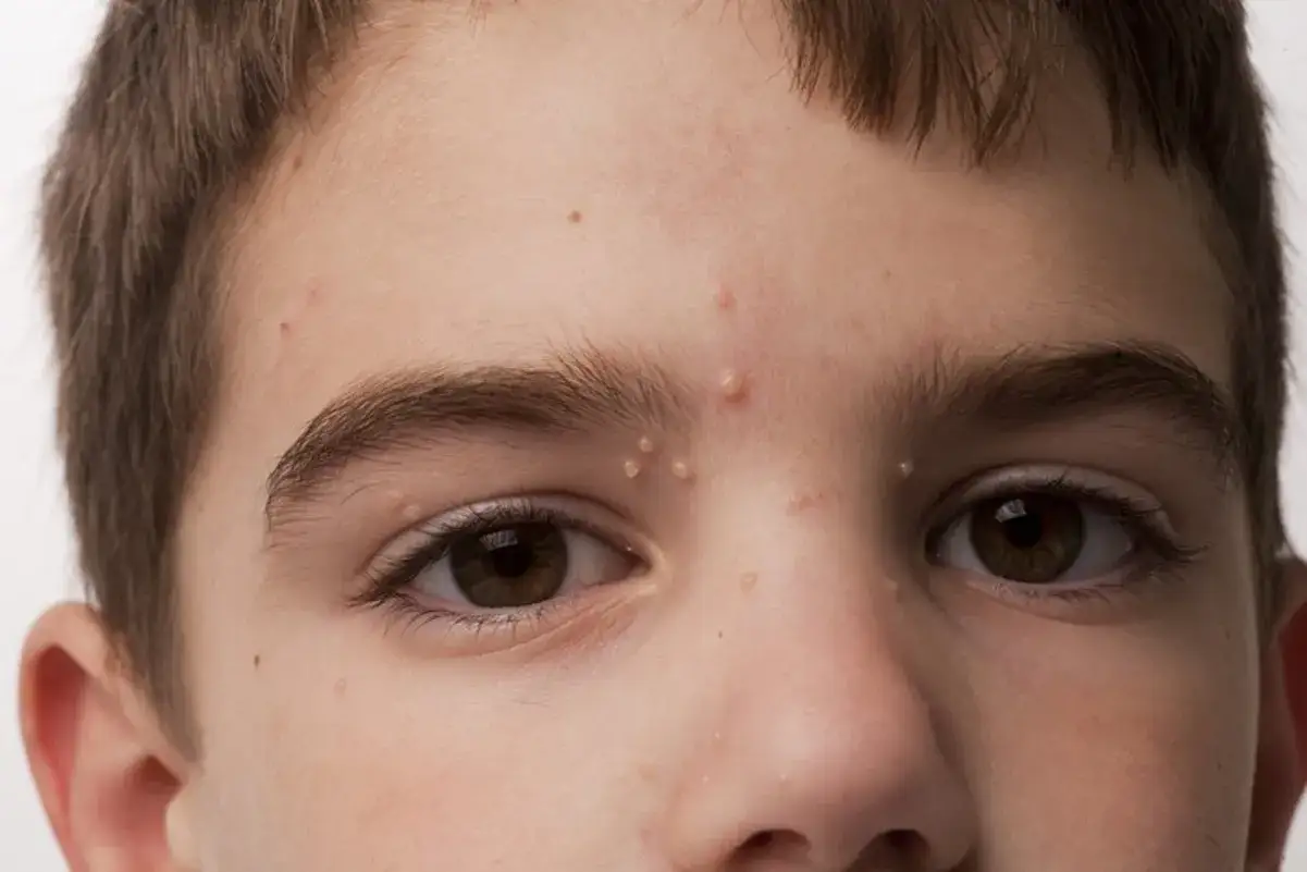 Primer plano de la cara de un niño con molusco contagioso.