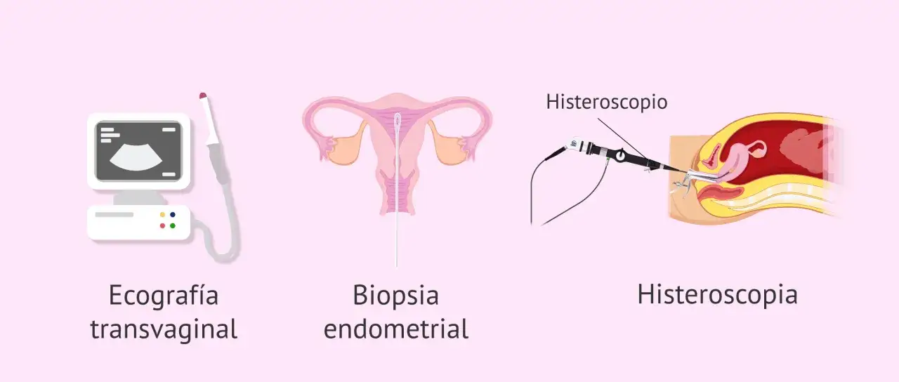 Ilustraci&oacute;n de ecograf&iacute;a transvaginal, biopsia endometrial y histeroscopia, m&eacute;todos para diagnosticar la hiperplasia de endometrio.