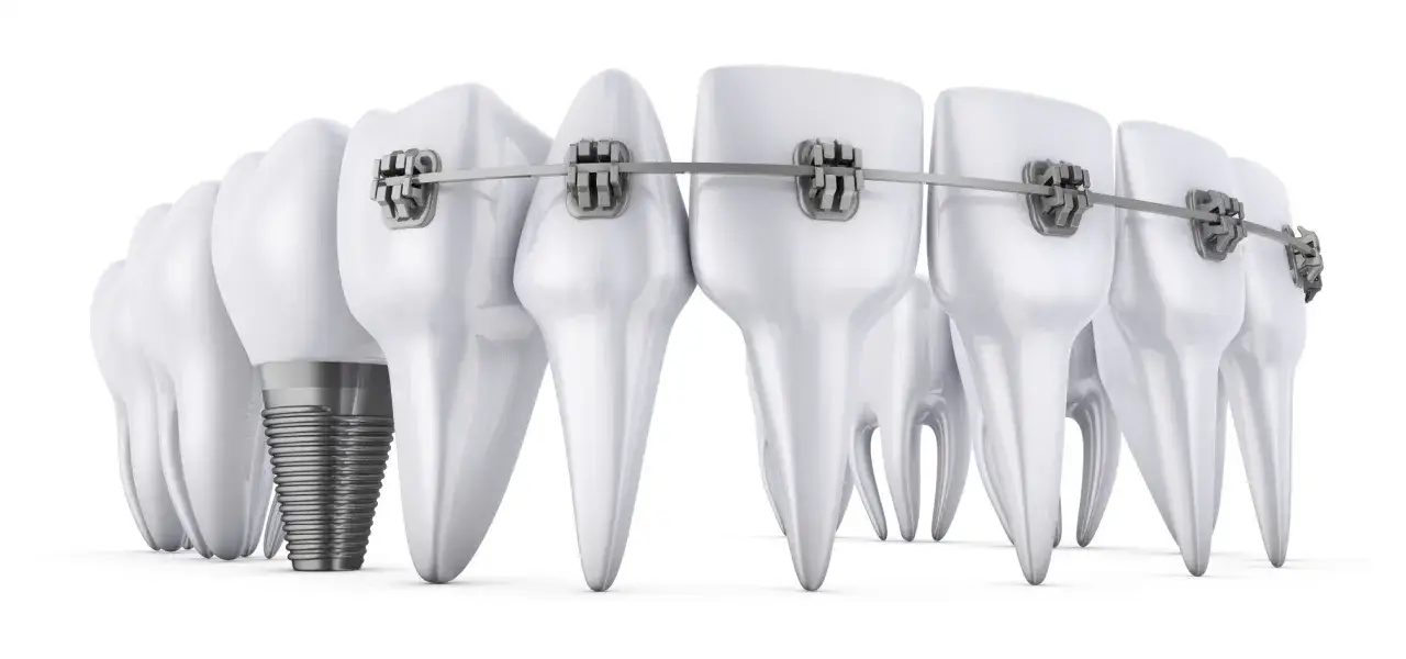 Prawidłowa higiena jamy ustnej z implantami