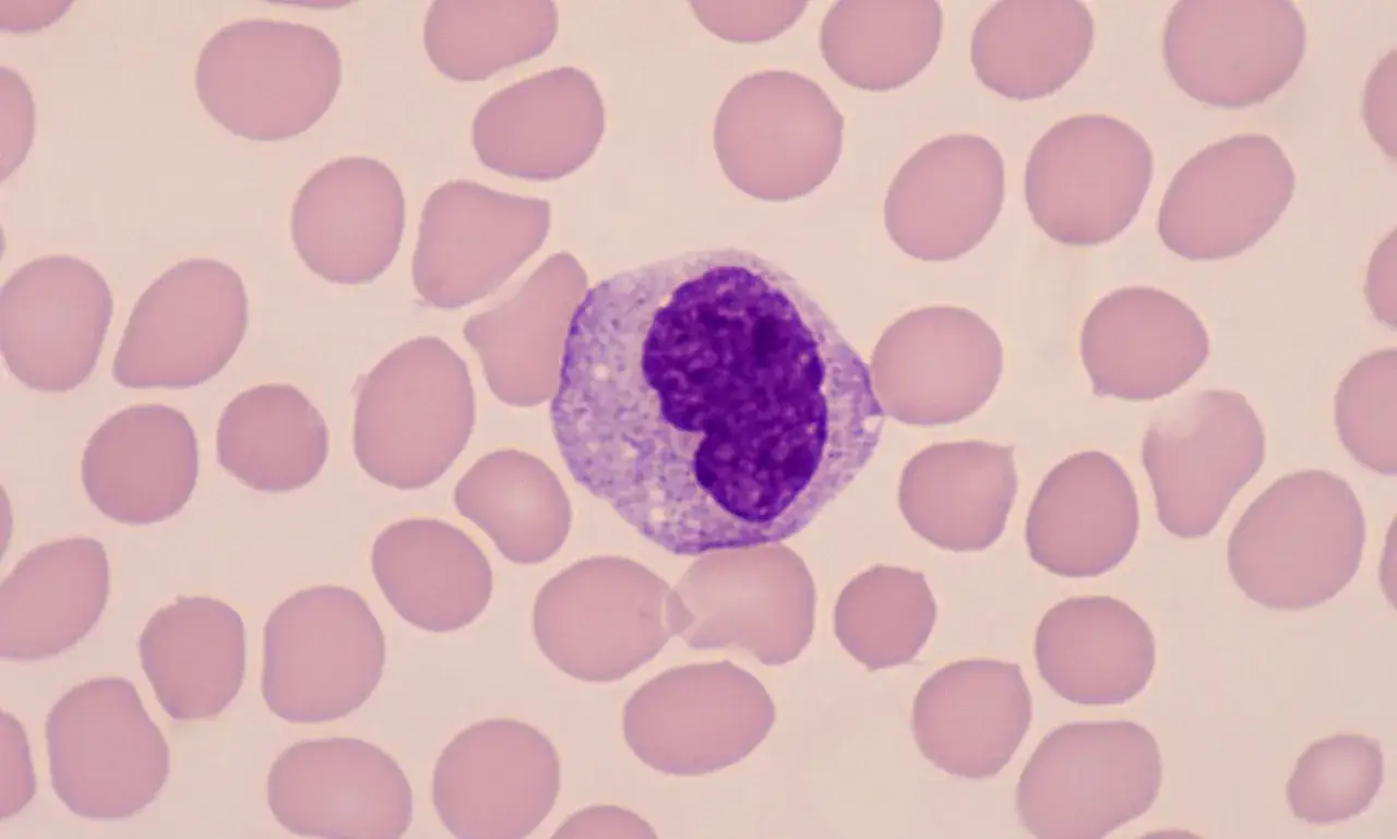 Ein einzelner Monozyt mit einem gro&szlig;en, violetten Kern inmitten vieler roter Blutk&ouml;rperchen. Dies k&ouml;nnte auf zu niedrige Monozyten im Blut hinweisen.